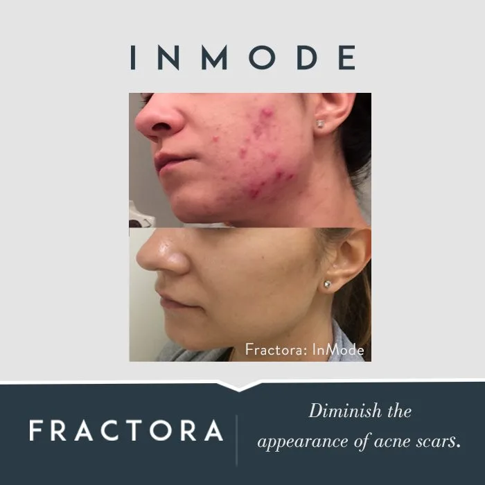 Before and after treatment of Inmode Fractora