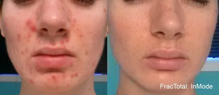Before and after Fractora treatment