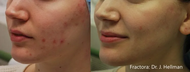 Before and after Fractora treatment by Dr. Hellman