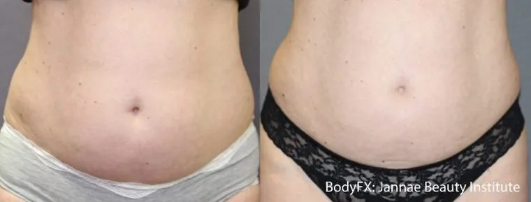 BodyFX before and after — abdomen