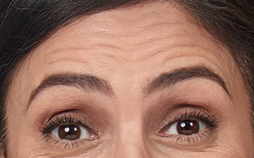 Forehead before Botox