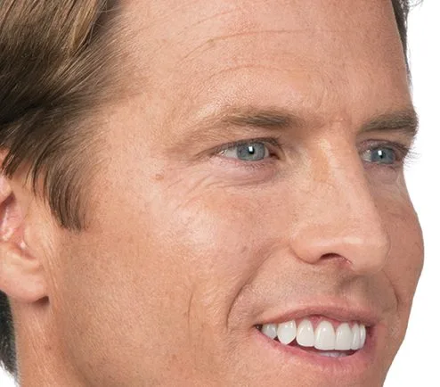 Side profile after Botox