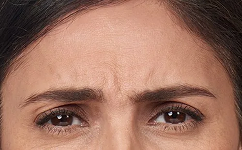 Frown lines before Botox