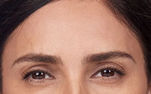 Frown lines after Botox