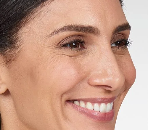 Side profile before Botox