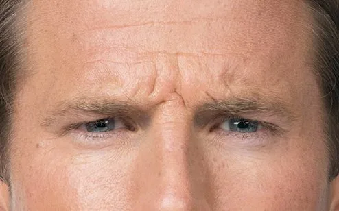 Forehead before Botox