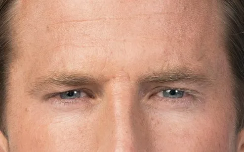 Forehead after Botox