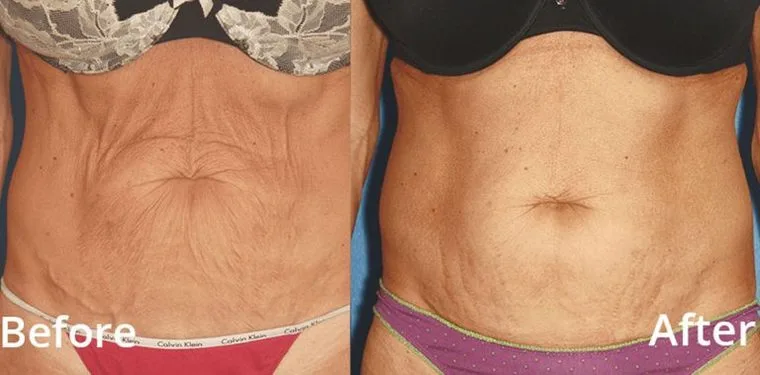 Before and after Forma — skin tightening