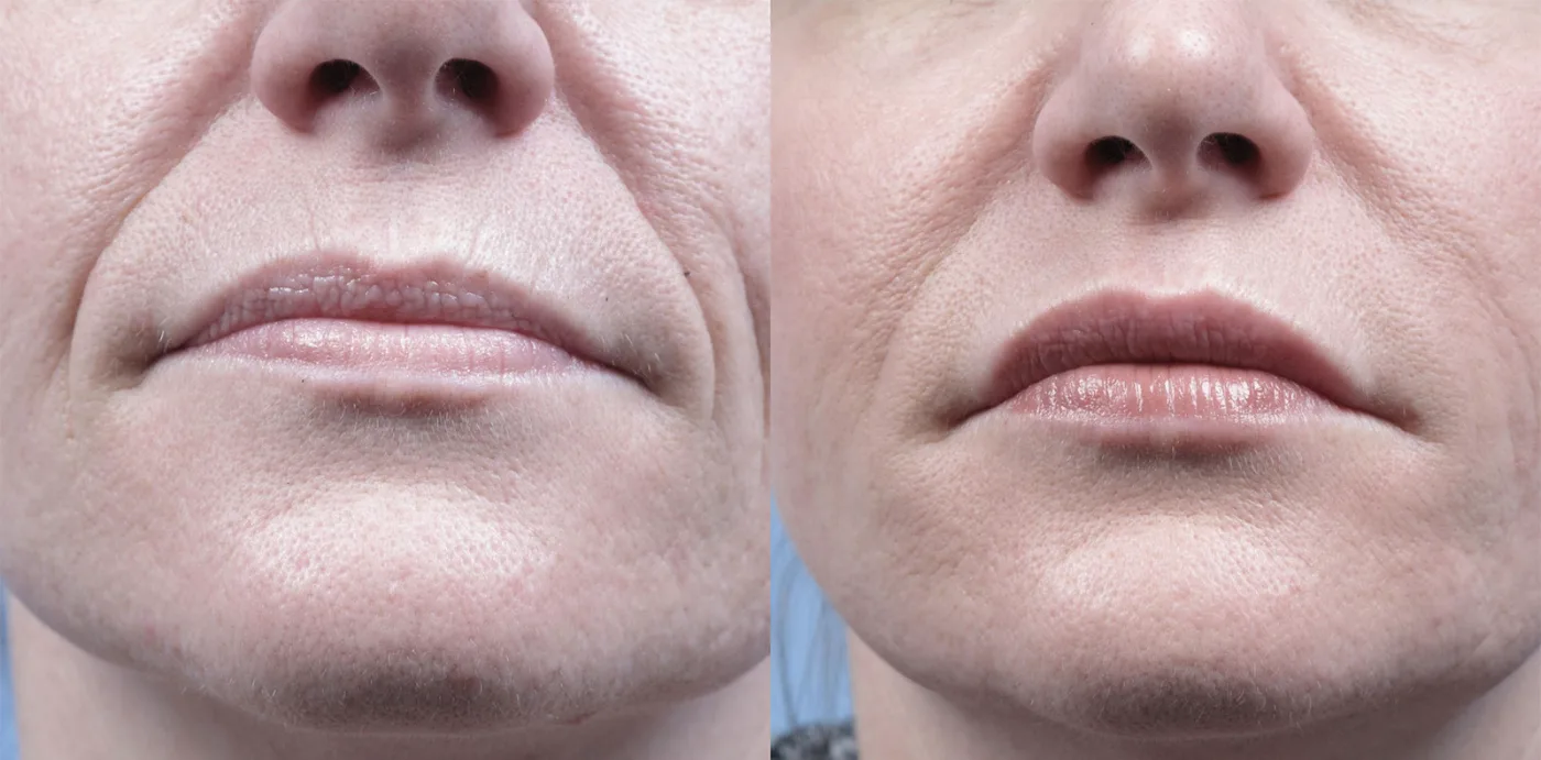 Before and after Forma — face tightening around mouth