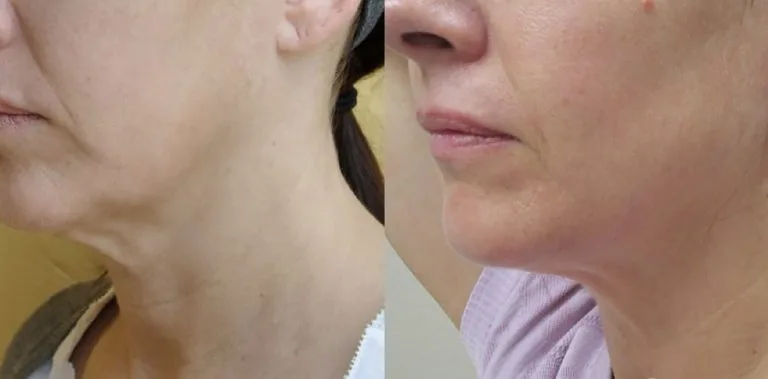 Before and after Forma — face and chin tightening