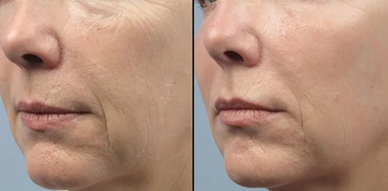 Before and after Forma — reduce wrinkles