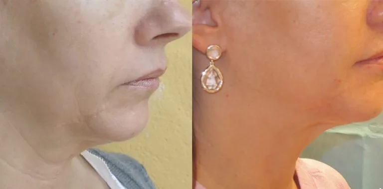 Before and after Forma — reduce double chin
