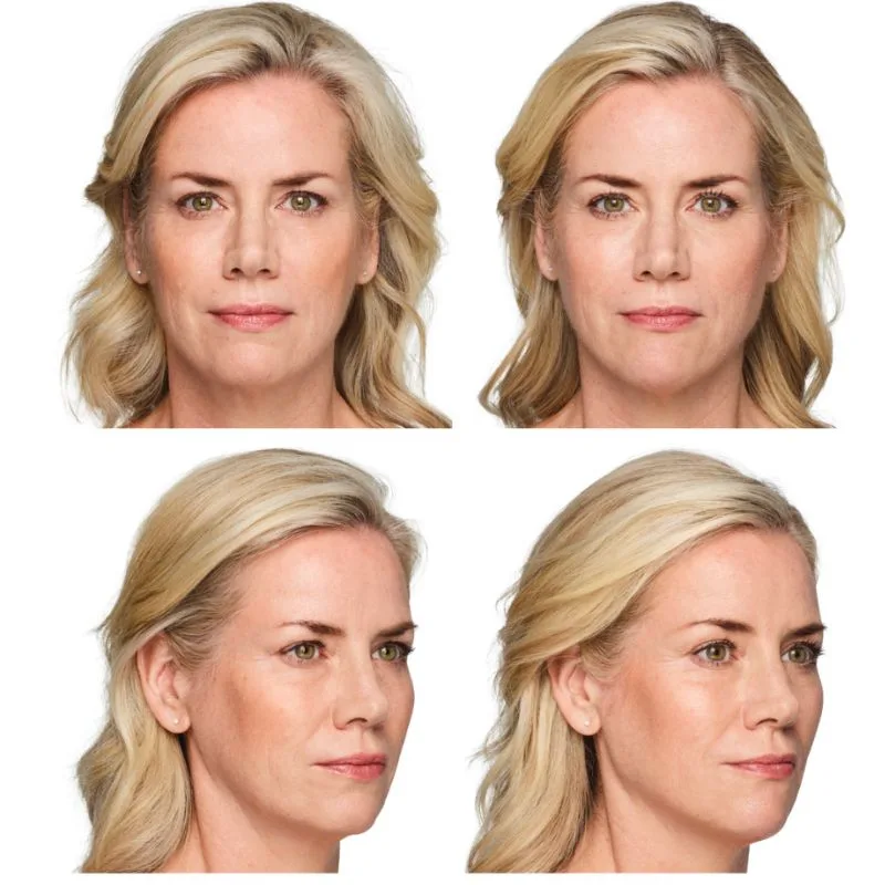 Before and after Juvederm Volux — woman