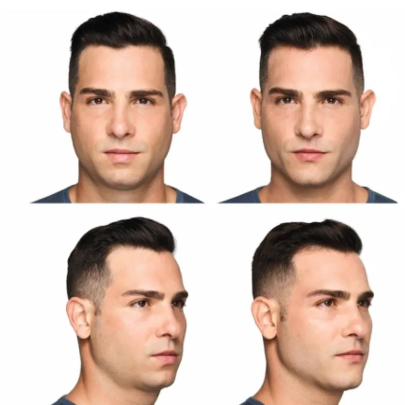 Before and after Juvederm Volux — man