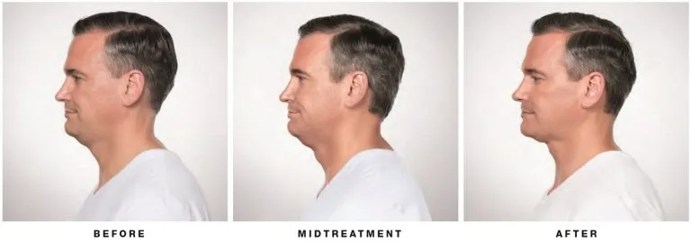 Before and after Kybella — side view, man