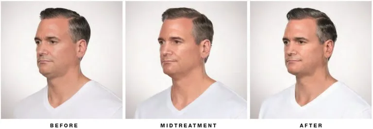 Before and after Kybella — partial side view, man