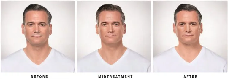 Before and after Kybella — front view, man