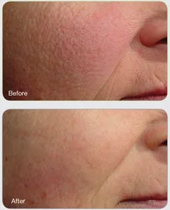 Before and after Laser Genesis — facial redness and rosacea