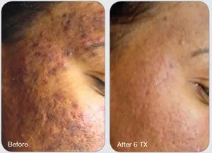 Before and after Laser Genesis — acne scarring, after 6 treatments