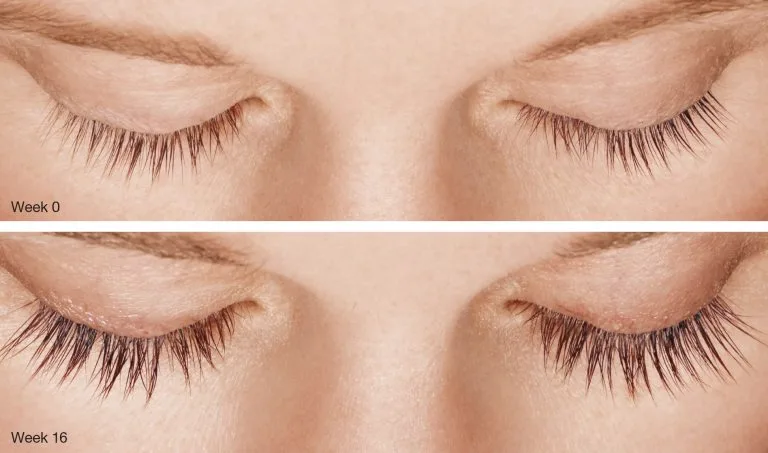 Before and after Latisse treatment — Week 0 to Week 16