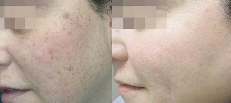 Before and after Lumecca — brown spots on face