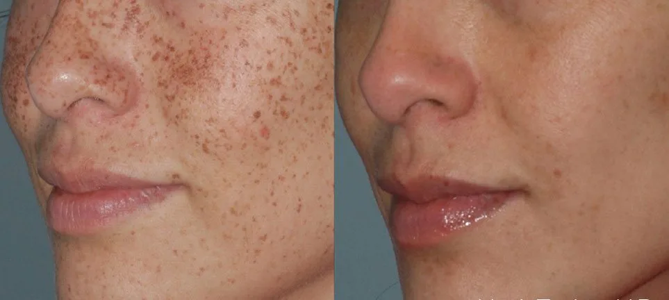 Before and after Lumecca — sun spots and freckles on face