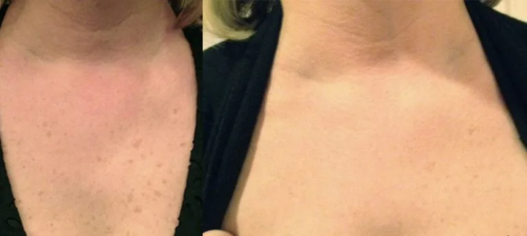 Before and after Lumecca — brown spots on chest