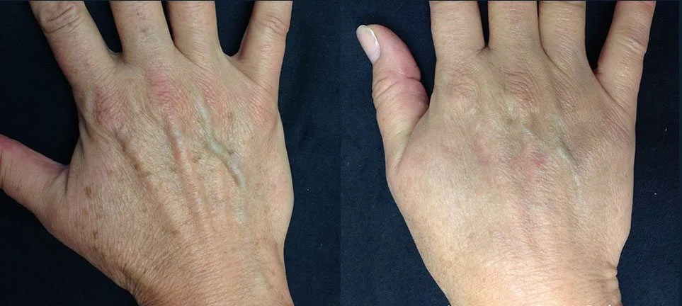 Before and after Lumecca — age spots on hands