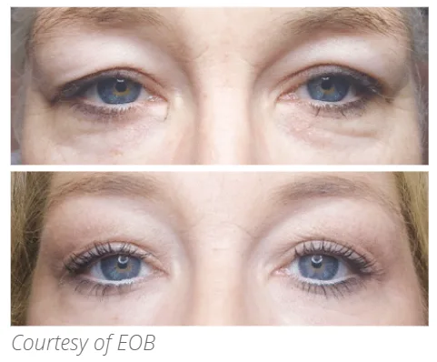 Before and after Subnovii treatment on eyes