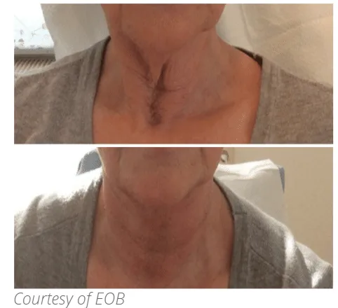 Before and after Subnovii treatment on neck