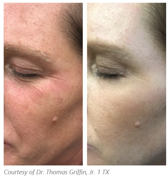 Before and after Subnovii treatment on wrinkles