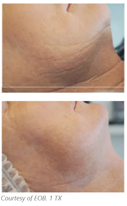 Before and after Subnovii treatment on neck and jawline