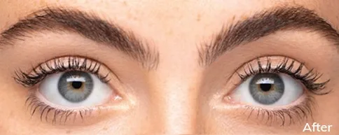 After Upneeq eyes