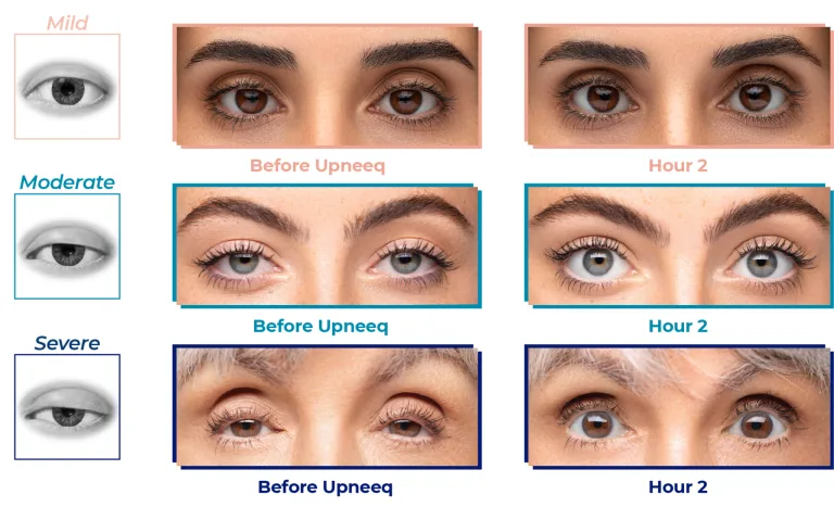 Before and after Upneeq eye lift treatment — mild, moderate, and severe